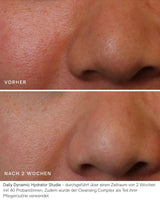 Vorher Nachher Daily Dynamic Hydrator Studie
