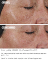 AGELESS+ Retinol IMAGE Skincare - pure liquid 0,1% vorher nachher ergebnisse