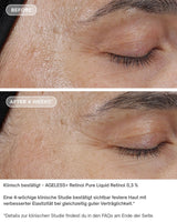 AGELESS+ Retinol - IMAGE SKincare - pure liquid 0,3% vorher / nachher ergebnisse