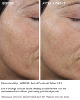 AGELESS+ Retinol - IMAGE SKincare - pure liquid 0,3% vorher / nachher ergebnisse