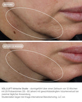 Vol.U.Lift von IMAGE Skincare - glp-1 4D skin rebound complex vorher nachher klinische ergebnisse