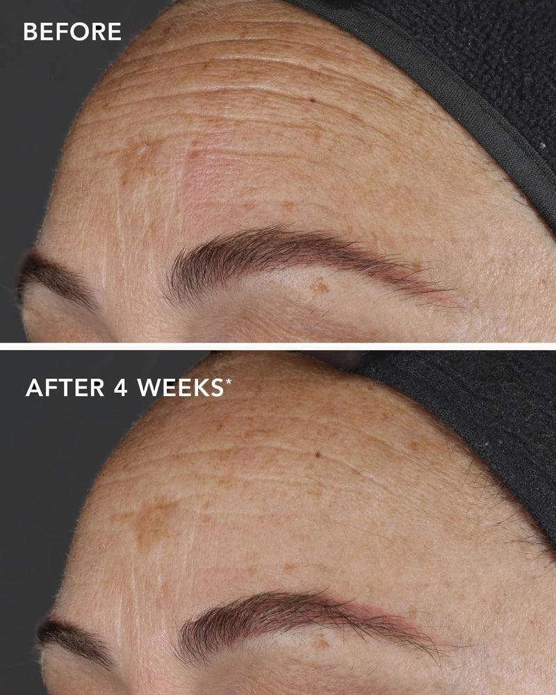 Ageless+ Retinol von IMAGE Skincare - Vorher Nachher klinische Studie - Pure liquid Retinol 0,1% 