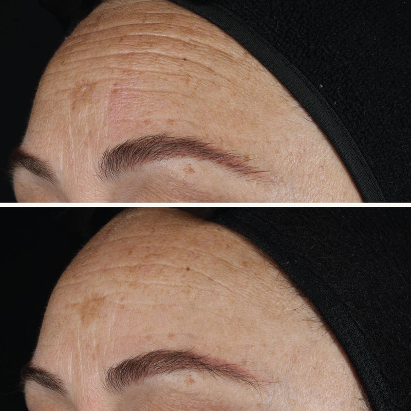 AGELESS+ Retinol IMAGE Skincare - pure liquid 0,1% - vorher - nachher