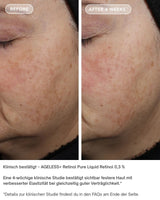 AGELESS+ Retinol - IMAGE SKincare - pure liquid 0,3% vorher / nachher ergebnisse