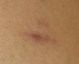 Narben_before